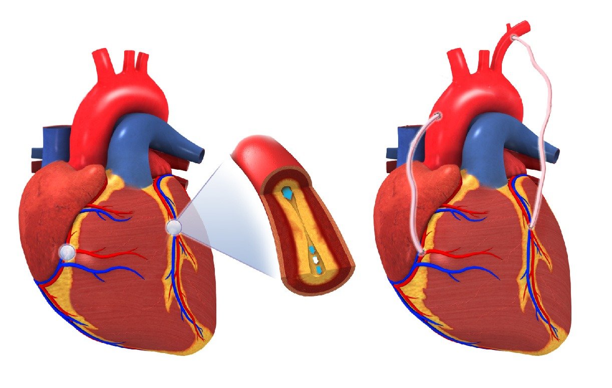 Heart Bypass Surgery (CABG) in India