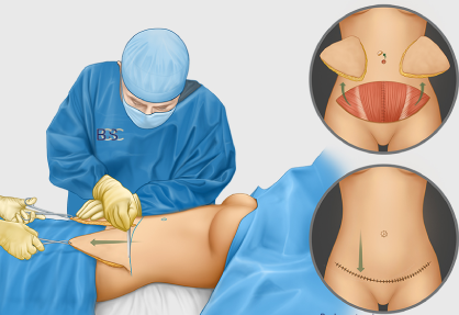 Abdominoplasty (Tummy Tuck) in India