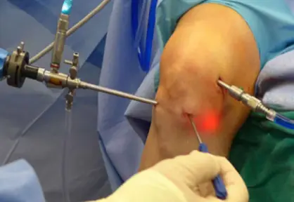 Arthroscopy (Arthroscopic Joint Surgery) in India