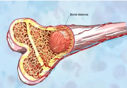 Bone Marrow Transplant (BMT) in India