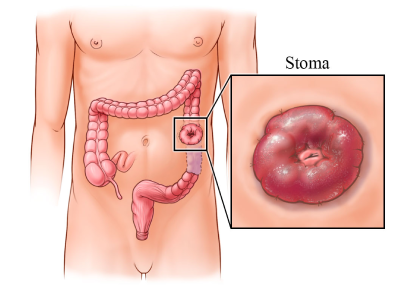 Bowel Resection and Anastomosis in India