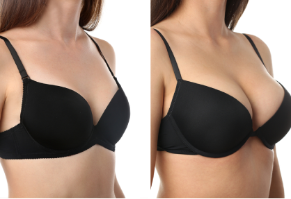 Breast Augmentation in India