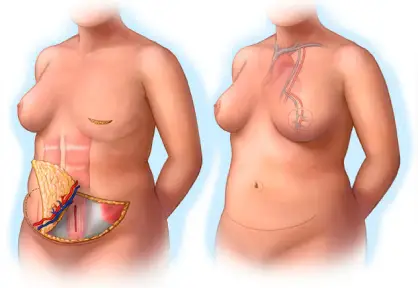 Breast Cancer Treatment in India