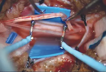 Cerebral Palsy Surgery in India
