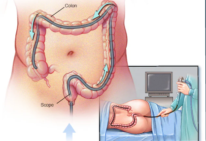 Colonoscopy in India