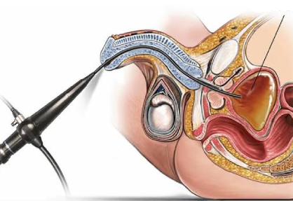 Cystoscopy in India