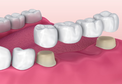 Dental Bridgework in India