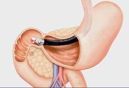 ERCP (Endoscopic Retrograde Cholangiopancreatography) in India