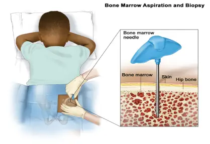 Ewing Sarcoma Treatment in India