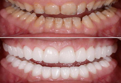 Full Mouth Rehabilitation in India