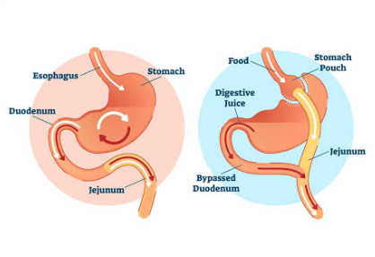 Gastric Bypass in India
