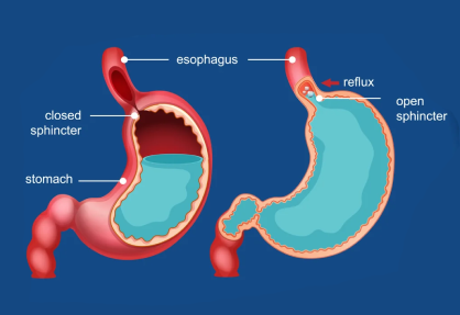 GERD Surgery (Laparoscopic Fundoplication) in India