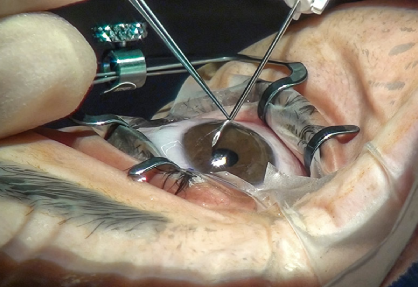 Glaucoma Surgery in India