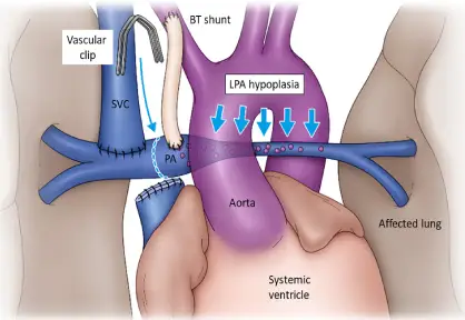 Glenn Shunt (Bidirectional Glenn Procedure) in India