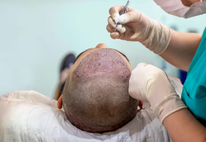 Hair Transplant Surgery in India