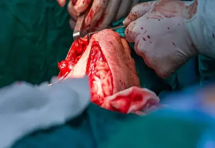 Head & Neck Cancer Surgery in India