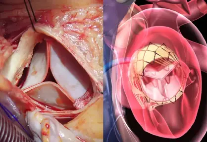 Heart Valve Replacement (Single/Double) in India