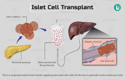 Pancreas or Islet Cell Transplant in India