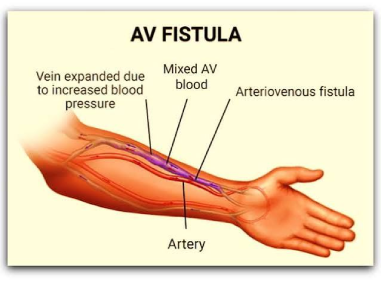 AV Fistula in India