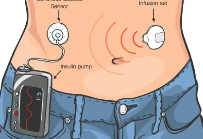 Insulin Pump Therapy in India