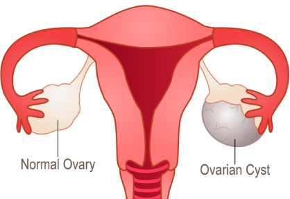 Ovarian Cyst Removal in India