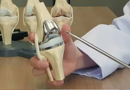 Knee Replacement Surgery (Unilateral/Bilateral) in India
