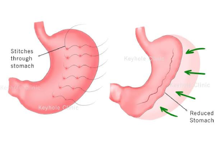 Laparoscopic Gastroplasty (Gastric Plication) in India