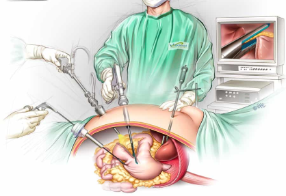 Laparoscopic Sleeve Gastrectomy in India