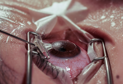 LASIK Surgery in India