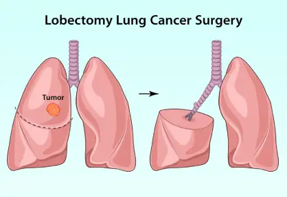 Lung Cancer Treatment / Lobectomy in India