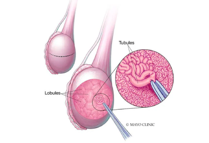 Micro Tesa Surgery in India