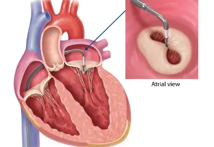 MitraClip (Transcatheter Mitral Valve Repair) in India