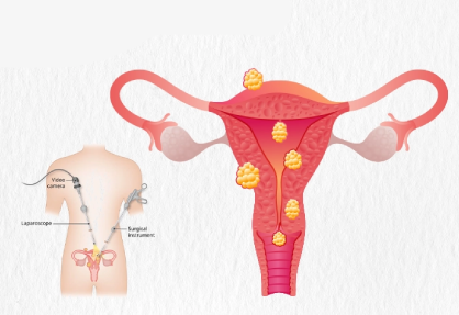 Myomectomy in India