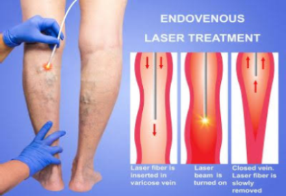 Endovenous Ablation in India