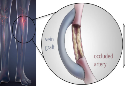 Vascular Bypass Surgery in India