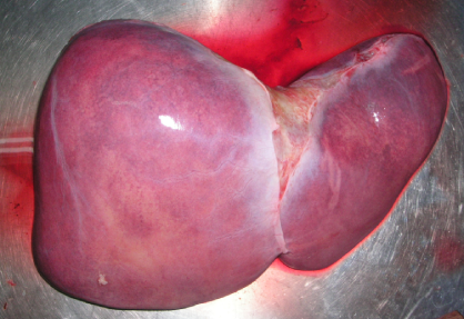 Liver Transplant in India
