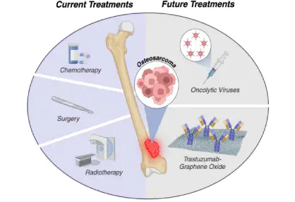 Osteosarcoma Treatment in India