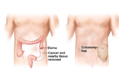 Ostomy Creation in India