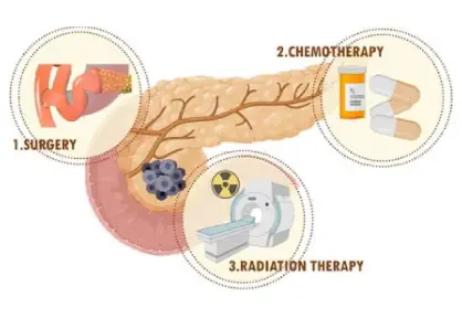 Pancreatic Cancer Treatment in India