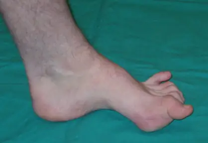 Pediatric Foot Deformities Treatment in India