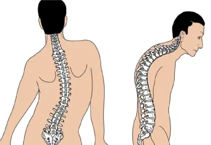 Pediatric Scoliosis and Kyphosis Surgery in India