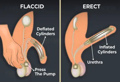 Penile Implant Surgery (Penile Prosthesis) in India