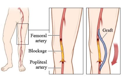 Peripheral Artery Bypass Surgery in India