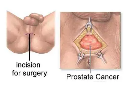 Prostate Cancer / Prostatectomy in India