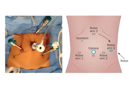 Rectal Cancer Surgery in India