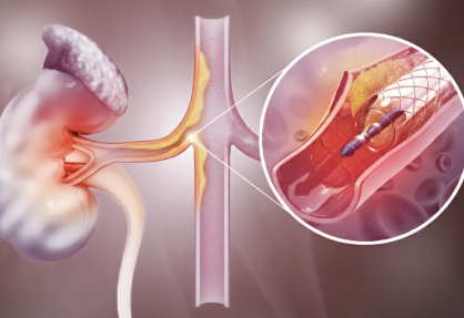 Renal Artery Angioplasty and Stenting in India