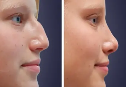 Rhinoplasty in India