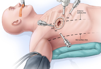 Robotic Mitral Valve Repair