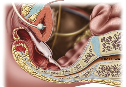 Sacral Colpopexy (Robotic Sacrocolpopexy)