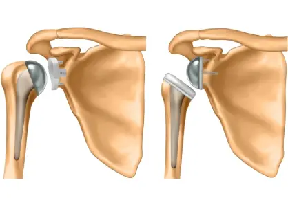 Shoulder Replacement Surgery in India